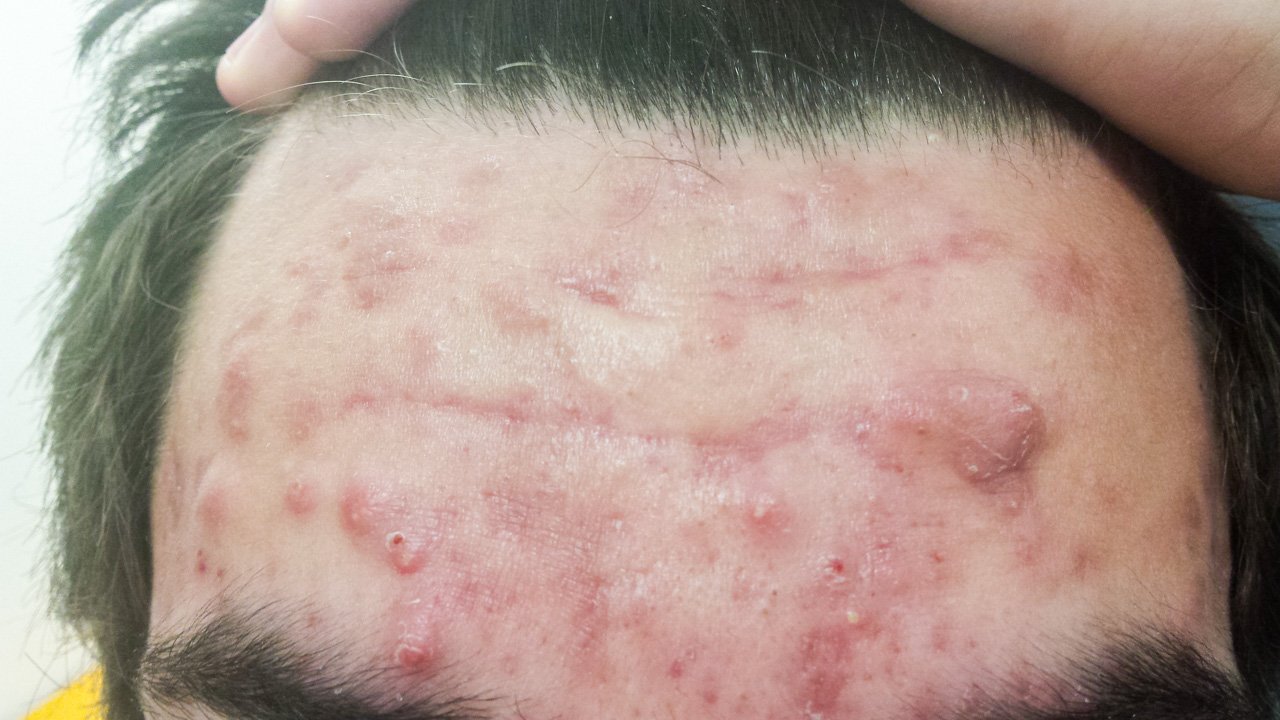 Acne on patients forehead before treatment