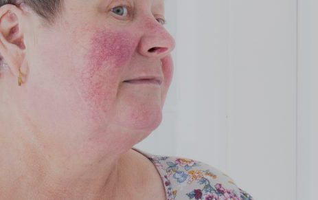 Rosacea is a long-term skin condition most commonly associated with facial redness – although it’s far more complex than many people realise and can have a significant psychological and social impact.