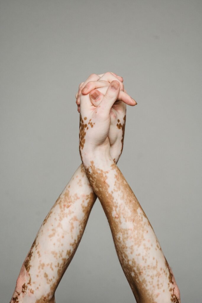 Vitiligo & Skin White Patches Treatment UK | The Dermatology Clinic London