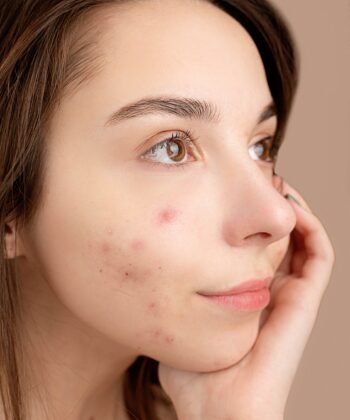 Girls With Acne