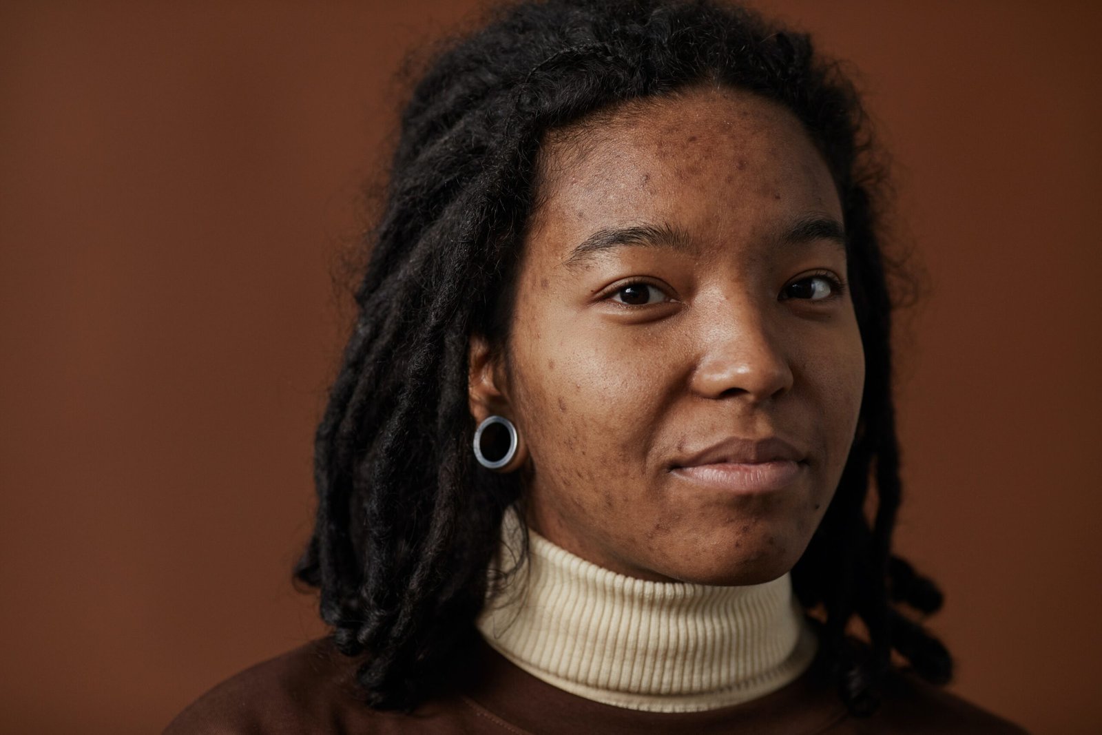 young lady with acne on face.