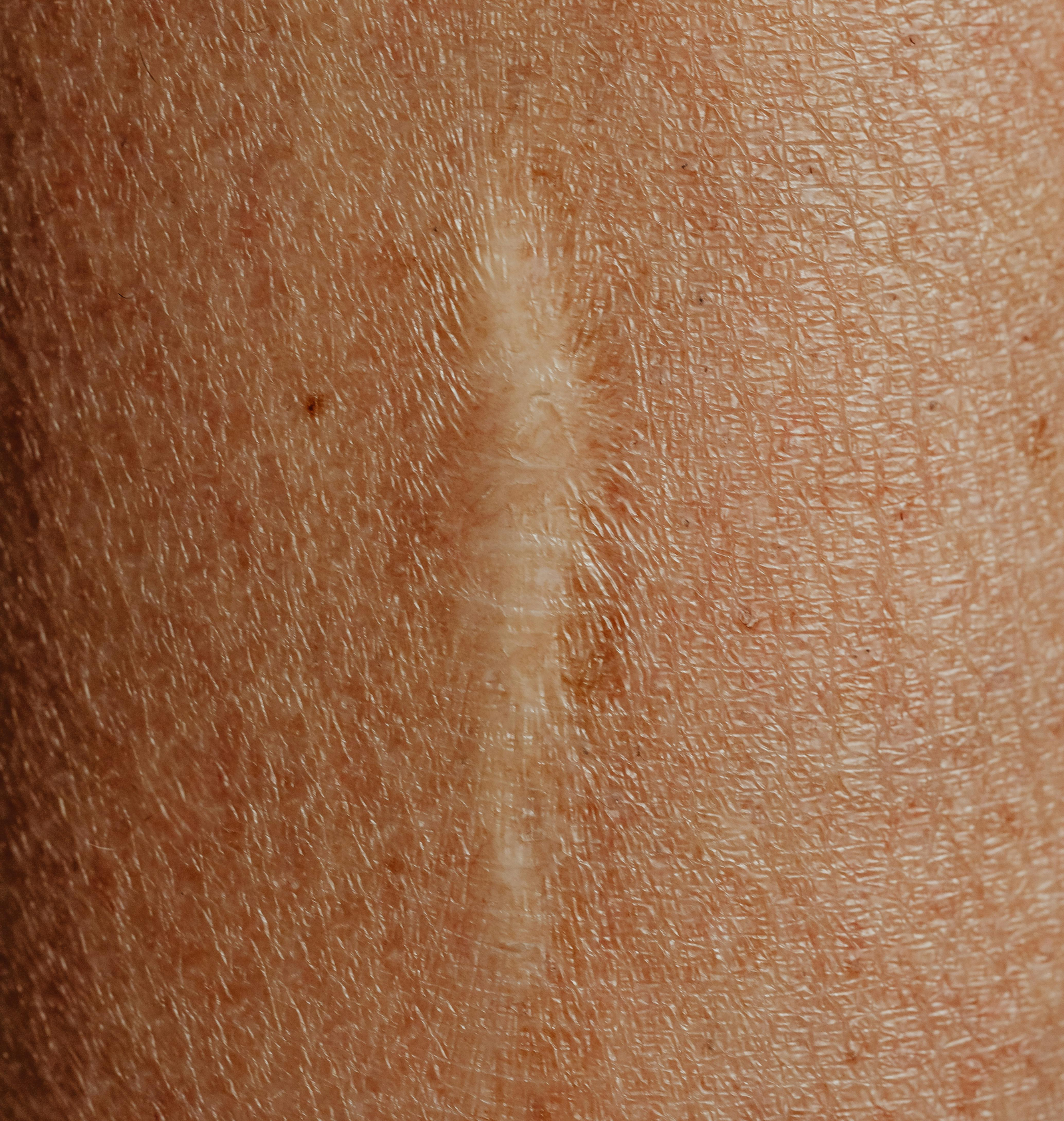 Close up Shot of Healed Scar on skin